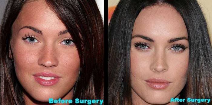 megan fox before surgery and after. megan fox surgery before after